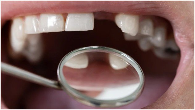 How Tooth Loss Changes What You Eat (and How You Feel)